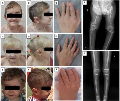 Complex Multisystem Phenotype With Immunodeficiency Associated With NBAS Mutations: Reports of Three Patients and Review of the Literature